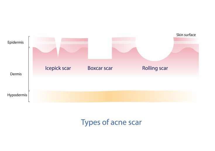 Các loại sẹo mụn