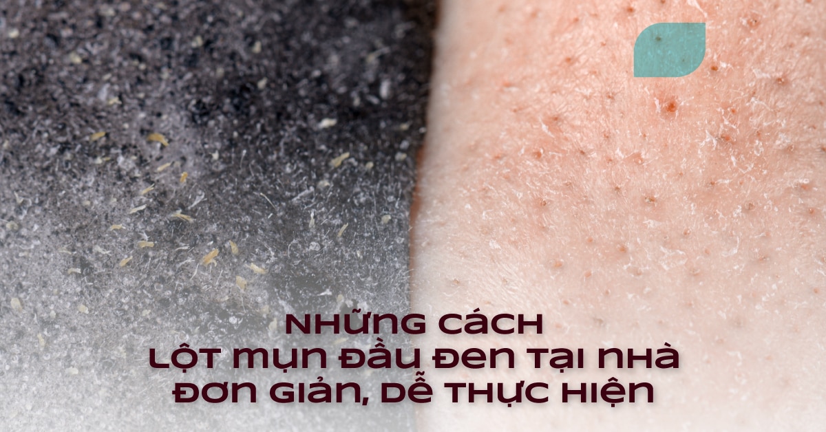 Những Lợi Ích Của Việc Lột Mụn Đầu Đen