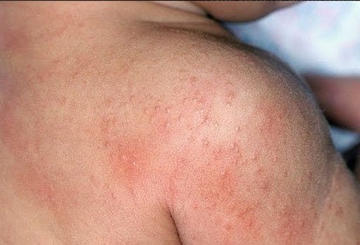 Những Vấn Đề Da Phổ Biến Ở Trẻ Nhỏ