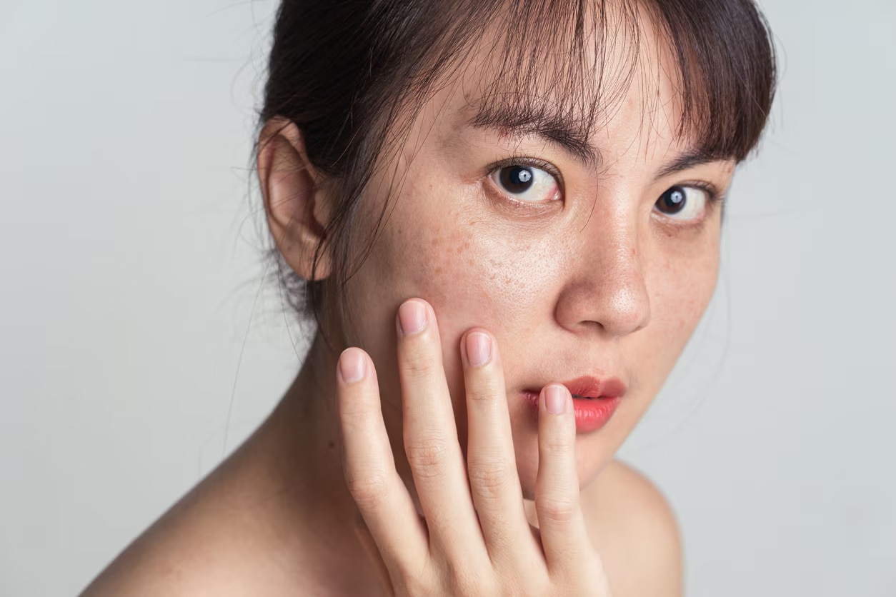 Da mặt ửng đỏ do kích ứng – cần mặt nạ làm dịu để phục hồi