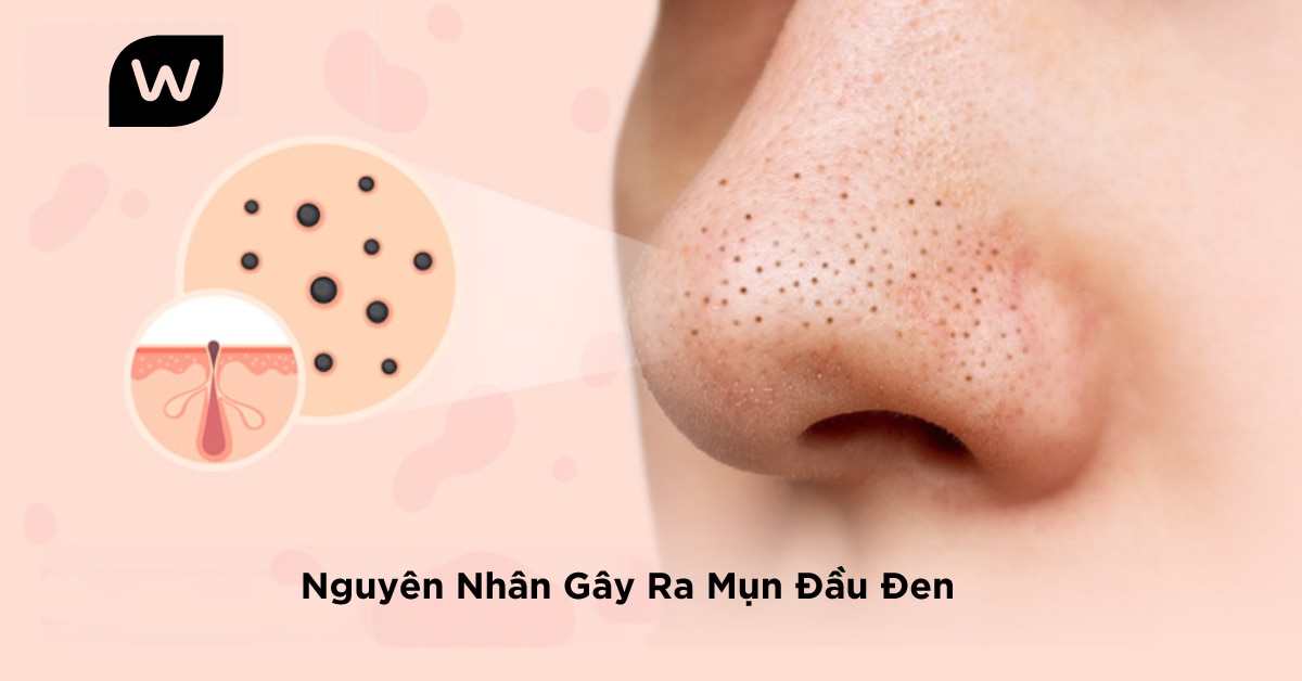 Nguyên Nhân Gây Mụn Đầu Đen Ở Mũi