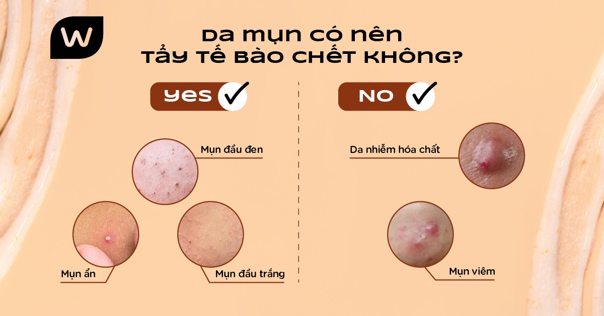 Tẩy Tế Bào Chết Đúng Cách Cho Da Mụn